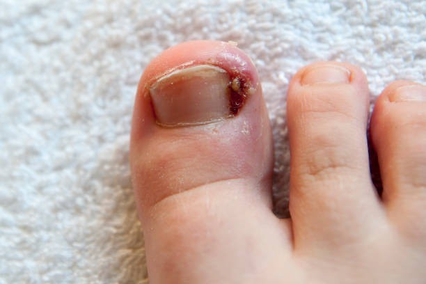 cantengan, kuku tumbuh ke dalam, ingrown toenail, cara mengatasi cantengan, penyebab cantengan, cara mencegah cantengan, kuku cantengan, kuku bernanah, kuku jempol sakit, kuku kaki bengkak